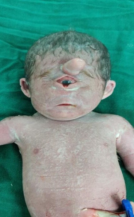 Frequent prenatal checkups can prevent severe birth defects such as cyclopia